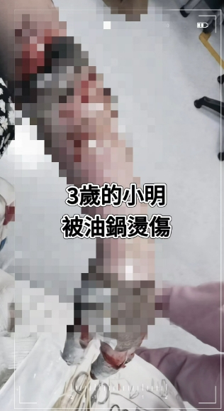用愛陪伴小勇士的燒燙傷復健之路
